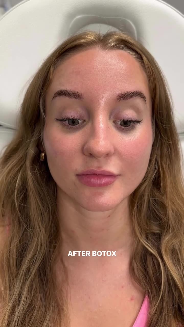 Wrinkle Relaxer TOX video